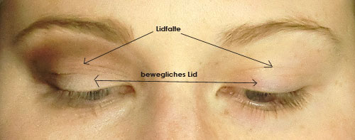 Definition Lidfalte und bewegliches Lid